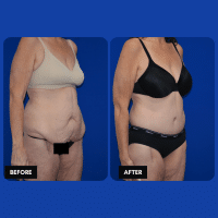 OLD FMPS B&A Template- Sanderson & Braswell Patients - 2025-12-8-360bodylift-01 (2)