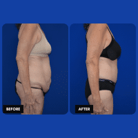 OLD FMPS B&A Template- Sanderson & Braswell Patients - 2025-12-8-360bodylift-01 (3)