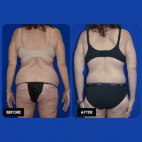 OLD FMPS B&A Template- Sanderson & Braswell Patients - 2025-12-8-360bodylift-01 (4)