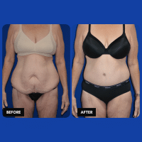 OLD FMPS B&A Template- Sanderson & Braswell Patients - 2025-12-8-360bodylift-01