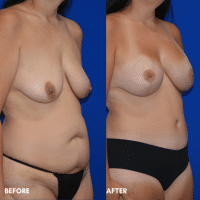 OLD FMPS B&A Template - mommy makeover (2)