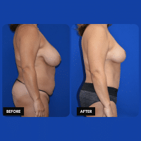 OLD FMPS B&A Template- Sanderson & Braswell Patients - 2026-12-1-mommymakeover-01 (2)