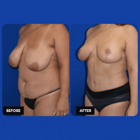 OLD FMPS B&A Template- Sanderson & Braswell Patients - 2026-12-1-mommymakeover-01 (3)