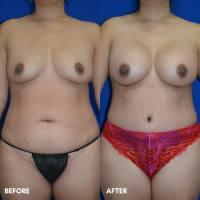 FMPS B&A Template - TT w lipo  of the flanks and lower abdomen BBA