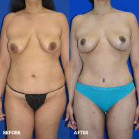 FMPS B&A Template - mommy makeover