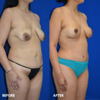 FMPS B&A Template - mommy makeover