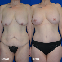 FMPS B&A Template - mommy makeover