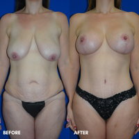 FMPS B&A Template - mommy makeover