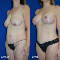 FMPS B&A Template - mommy makeover