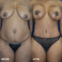 FMPS B&A Template - mommy makeover