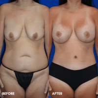 OLD FMPS B&A Template - mommy makeover
