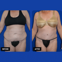 OLD FMPS B&A Template- Sanderson & Braswell Patients - 2025-09-25-tummytuck-liposuctionoftheflanks-01