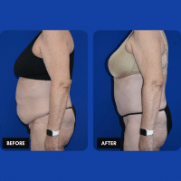 OLD FMPS B&A Template- Sanderson & Braswell Patients - 2025-09-25-tummytuck-liposuctionoftheflanks-03