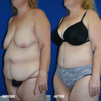 FMPS B&A Template - tummy tuck w lipo of the flanks