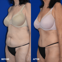 OLD FMPS B&A Template - TT w/ flank lipo (2)
