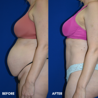 FMPS B&A Template - TT with liposuction of the flanks