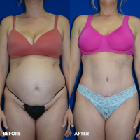FMPS B&A Template - TT with liposcution of the flanks
