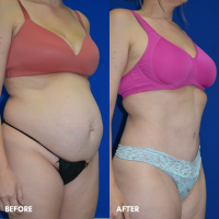 FMPS B&A Template - TT with liposuction of the flanks