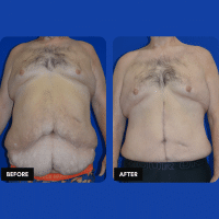 OLD FMPS B&A Template - extended TT, flank lipo, fleur-de-lis