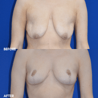OLD FMPS B&A Template- Sanderson & Braswell Patients - 10-16-25-mastopexy-01