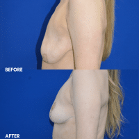 OLD FMPS B&A Template- Sanderson & Braswell Patients - 10-16-25-mastopexy-01 (2)