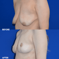 OLD FMPS B&A Template- Sanderson & Braswell Patients - 10-16-25-mastopexy-01 (3)