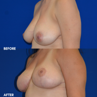 FMPS B&A Template - breast lift 1 angle