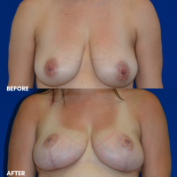 FMPS B&A Template - breast lift 1 front