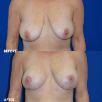 FMPS B&A Template - breast lift