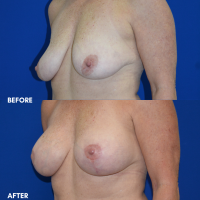 FMPS B&A Template - breast lift