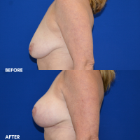 FMPS B&A Template - breast lift