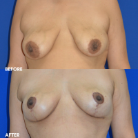 FMPS B&A Template - breast lift