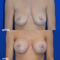 OLD FMPS B&A Template- Sanderson & Braswell Patients - 2025-12-29-breastaugmentation-mastopexy-01