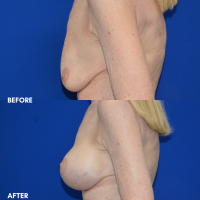 FMPS B&A Template - MASTOPEXY W SILICONE IMPLANTS