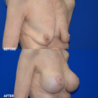 FMPS B&A Template - MASTOPEXY W SILICONE IMPLANTS