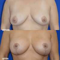 OLD FMPS B&A Template - breast aug with a lift