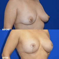 OLD FMPS B&A Template - breast aug with a lift (2)