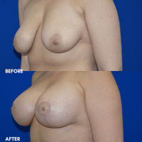 FMPS B&A Template - breast augmentation & mastopexy