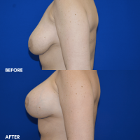 FMPS B&A Template - breast augmentation & mastopexy