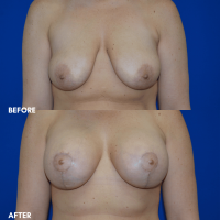 FMPS B&A Template - breast augmentation & mastopexy