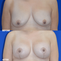 OLD FMPS B&A Template - MASTOPEXY W IMPLANTS
