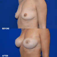 OLD FMPS B&A Template- Sanderson & Braswell Patients - 2025-11-17-breastaugmentation-01 (2)