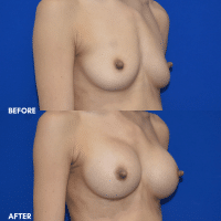 OLD FMPS B&A Template - Angle BBA
