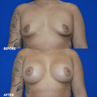 FMPS B&A Template - breast augmentation