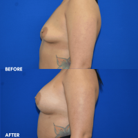 FMPS B&A Template - breast augmentation