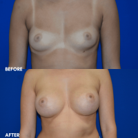 FMPS B&A Template - breast augmentation