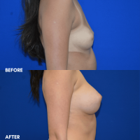 FMPS B&A Template - breast augmentation