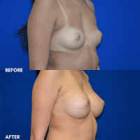 FMPS B&A Template - breast augmentation