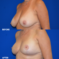 FMPS B & A - breast reduction 1 angle