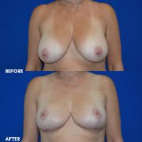 FMPS B & A  - breast reduction 1